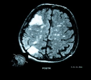 MRI scan of brain lesion. Image: xpixel/Shutterstock.com