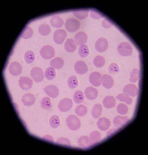 Plasmodium falciparum under a microscope. Image: toeytoey/Shutterstock.com