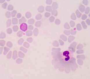 Blood films for malaria parasite. Image: toeytoey/Shutterstock.com