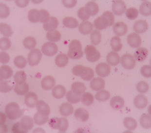 Plasmodium falciparum infections red blood cells. Image: plenoy m/Shutterstock.com.