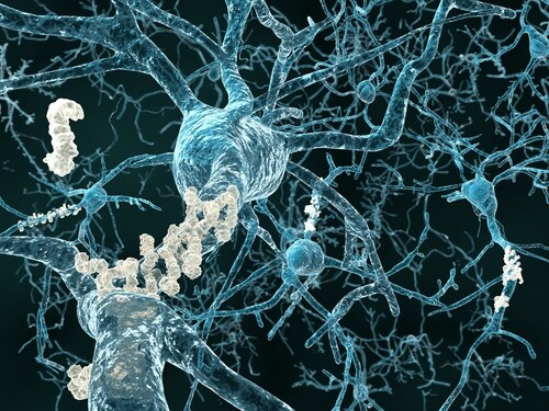 Alzheimer's disease - neurons with amyloid plaques. Image: Juan Gaertner/Shutterstock.com.