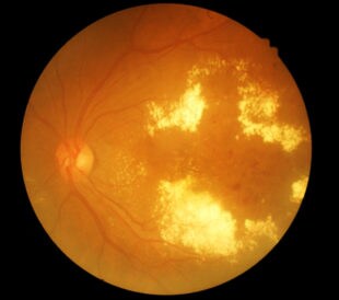 Retina of diabetic - diabetic retinophaty. Image: memorisz/Shutterstock.com.