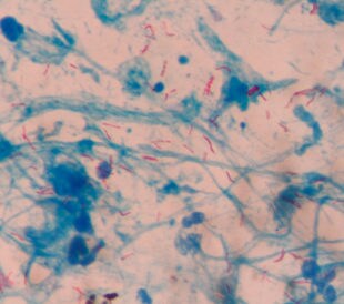 Mycobacterium tuberculosis gram-negative bacteria. Image: plenoy m/Shutterstock.com.