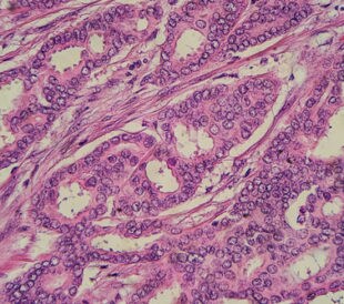 Breast cancer histology: Microscopic image of a well differentiated, grade 1, infiltrating (invasive) ductal carcinoma (photographed and uploaded by US board-certified surgical pathologist). Image: David Litman/Shutterstock.com.