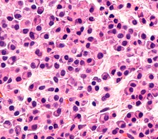 Myeloma awareness: Microscopic image of bone biopsy showing multiple myeloma, a type of bone marrow cancer of malignant plasma cells. It is associated with bone pain, bone fractures and anemia. Image: David Litman/Shutterstock.com.
