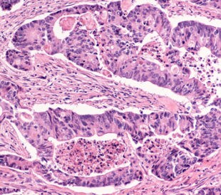 Colon cancer: Photomicrograph (microscopic image) of an invasive colonic adenocarcinoma. Screening colonoscopy can detect precancerous polyps (adenomas) and prevent colon cancer. Image: David Litman/Shutterstock.com.