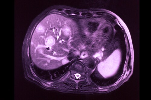 Hepatocellular carcinoma