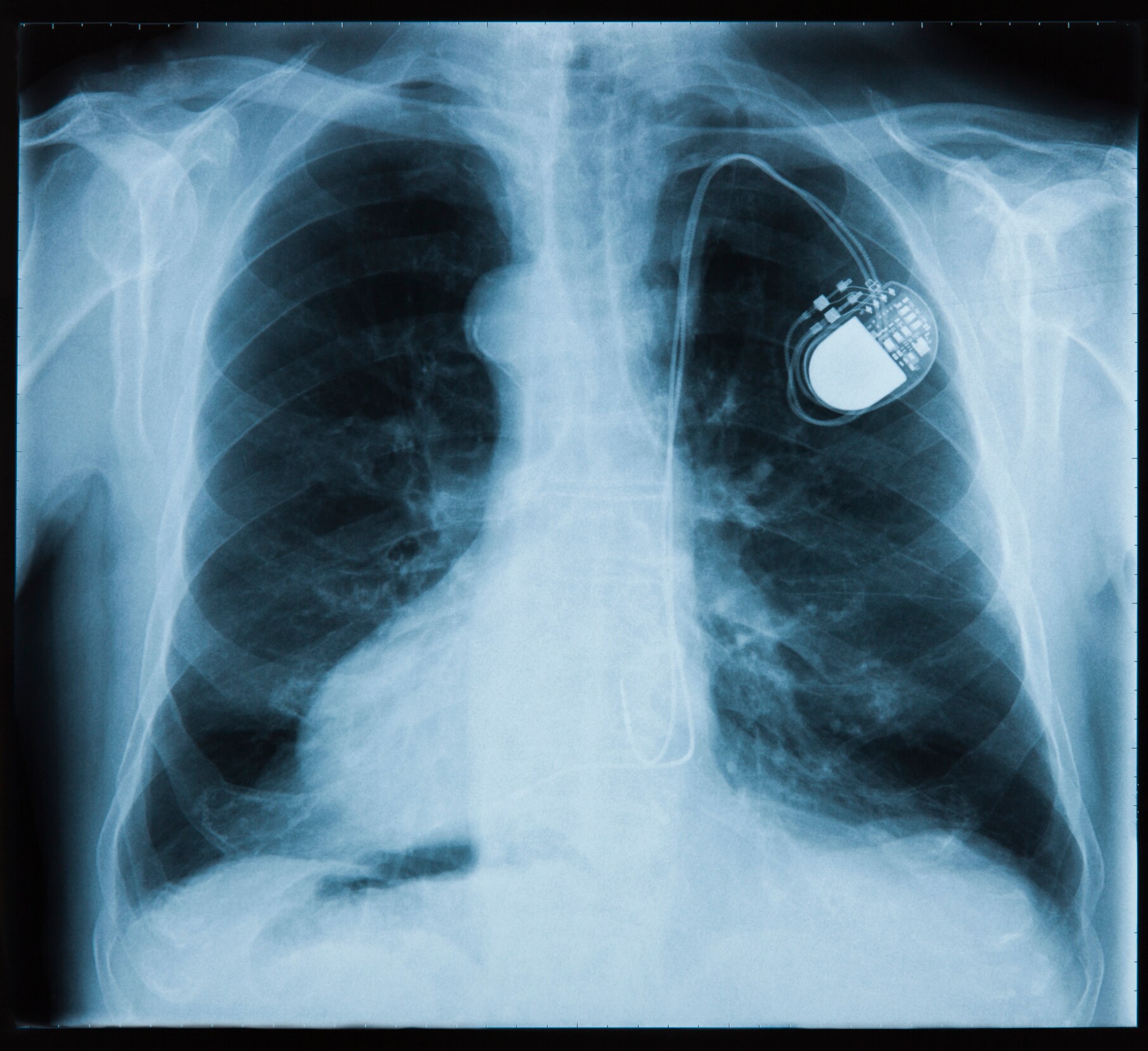 Most pacemakers contain at least two platinum-iridium electrodes. 