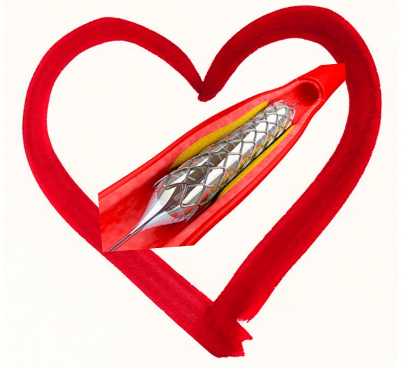 heart stent