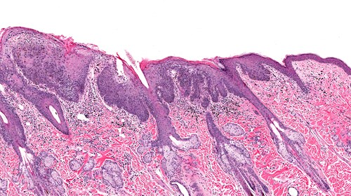 Image showing squamous cell carcinoma (in situ) on the left and relatively normal skin on the right.  Image: vetpathologist/Shutterstock.com