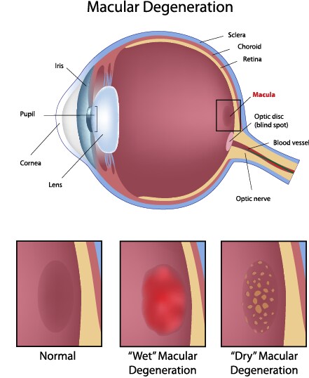 macular degeneration