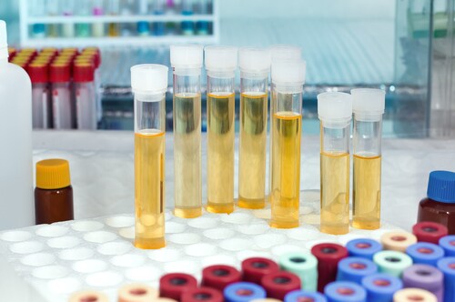 Rack with several urine samples. Image: angellodeco/Shutterstock.com