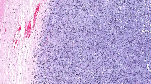 Microscopic view of oligodendroglioma of the brain (right half in blue) and normal brain (pink portion on left). The brain cancer has invaded and replaced normal healthy brain tissue. Glioma of brain. Image: vetpathologist/Shutterstock.com..