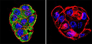 Immunofluorescent analysis of CFTR using an antibody recognizing CFTR shows staining in WiDr colon carcinoma cells Immunofluorescent analysis of CFTR using an antibody recognizing CFTR shows staining in WiDr colon carcinoma cells