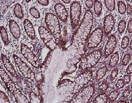 ihc-cytokeratin-poly-270x210 ihc-cytokeratin-poly-270x210