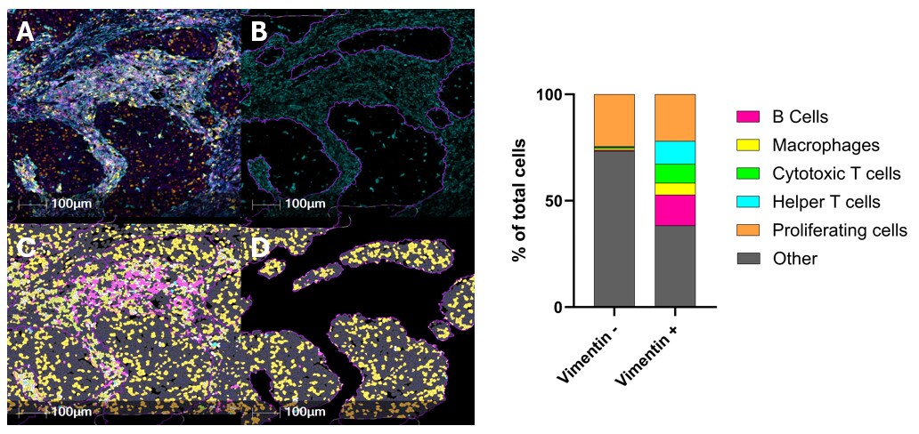 Single cell analysis of invasive ductal carcinoma tissue using HALO software 4-panel fluorescence microscopy image and distribution graph