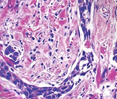 Oncology Research with Laser Capture Microdissection (LCM) Oncology Research with Laser Capture Microdissection (LCM)