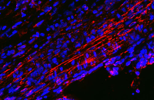 Fluorescene IHC detection of cytokeratin 18 in colon carcinoma tissue Fluorescene IHC detection of cytokeratin 18 in colon carcinoma tissue