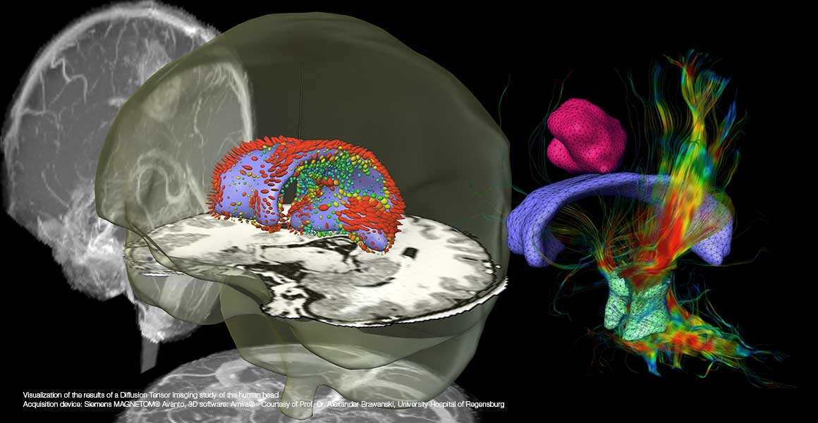 Visualization of the results of a Diffusion Tensor Imaging study of the human head Visualization of the results of a Diffusion Tensor Imaging study of the human head