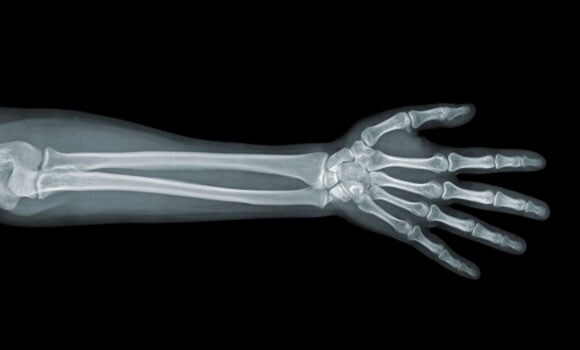 X-ray Arm X-ray Arm