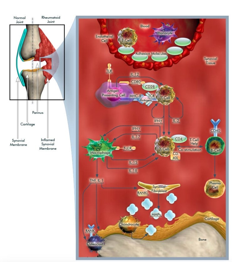 Pathogenesis of Rheumatoid Arthritis Pathogenesis of Rheumatoid Arthritis