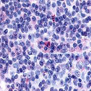Immunohistochemical analysis of aromatase PA1-21398 Immunohistochemical analysis of aromatase PA1-21398