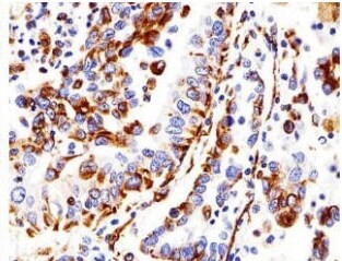 癌症组织 癌症组织