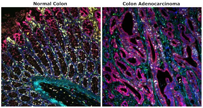 Multiplexed Colon Tissue Panel Side by side panel of multiplexed healthy colon tissue and diseased colon tissue
