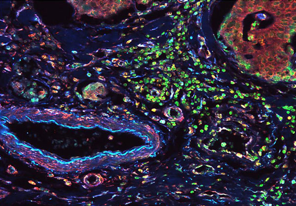 Fluorescent IHC detection of vimentin and lamin B1 in normal colon tissue. Fluorescent IHC detection of vimentin and lamin B1 in normal colon tissue.