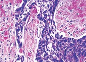Detection of Tumor Markers—IHC Solutions Detection of Tumor Markers—IHC Solutions