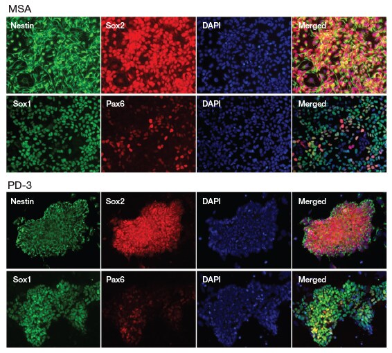 对受 MSA 和 PD 影响供体产生的 NSC 上的 NSC 特异性标志物进行的免疫细胞化学检测 显示对受 MSA 和 PD 影响供体产生的 NSC 上的 NSC 特异性标志物进行免疫细胞化学检测的多组图像
