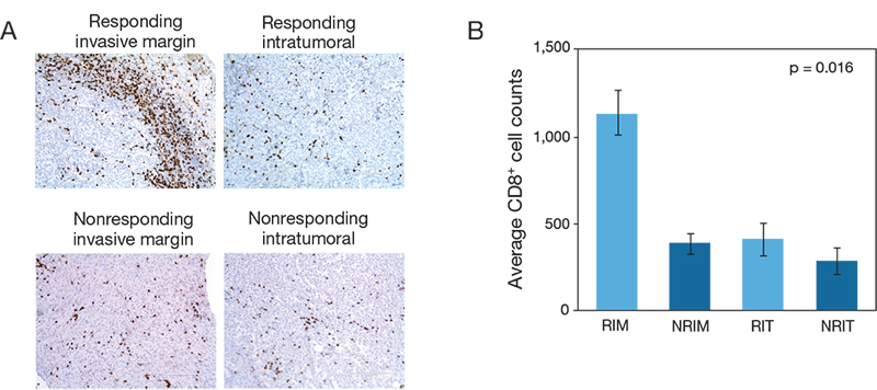 Tumors responding to treatment show increased T cell infiltration prior to therapy Tumors responding to treatment show increased T cell infiltration prior to therapy