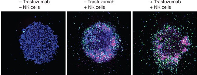 Antibody-dependent cell killing in breast cancer spheroids Antibody-dependent cell killing in breast cancer spheroids