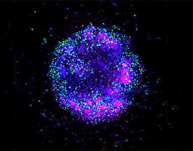 Natural killer (NK) cells invading breast cancer spheroids Natural killer (NK) cells invading breast cancer spheroids